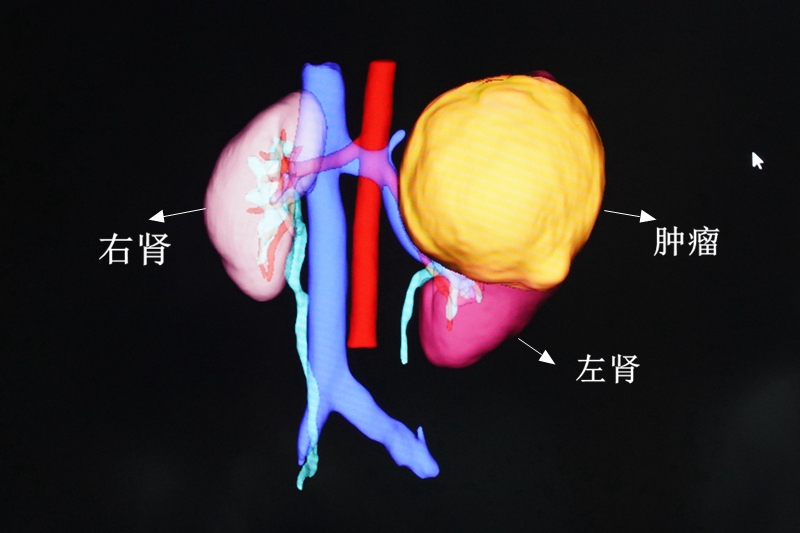 C:\Users\admin\Desktop\20230522泌尿外科10歲女童左腎長巨大腫瘤，宛如第三個腎臟\DSC06254.JPG